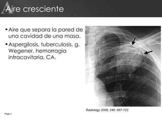 Aire cresciente Aire que separa la pared de una cavidad de una masa. Aspergilosis, tuberculosis, g. Wegener, hemorragia intracavitaria, CA. A Page     Radiology 2008; 246: 697-722 