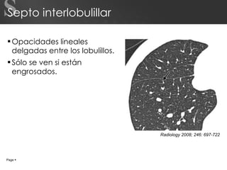 Septo interlobulillar Opacidades lineales delgadas entre los lobulillos. Sólo se ven si están engrosados. S Page     Radiology 2008; 246: 697-722 