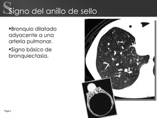 Signo del anillo de sello Bronquio dilatado adyacente a una arteria pulmonar. Signo básico de bronquiectasia. Page     S 