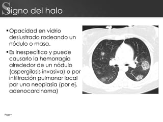 Signo del halo Opacidad en vidrio deslustrado rodeando un nódulo o masa. Es inespecífico y puede causarlo la hemorragia alrededor de un nódulo (aspergilosis invasiva) o por infiltración pulmonar local por una neoplasia (por ej. adenocarcinoma) Page     S 