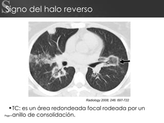 Signo del halo reverso TC: es un área redondeada focal rodeada por un anillo de consolidación. S Page     Radiology 2008; 246: 697-722 