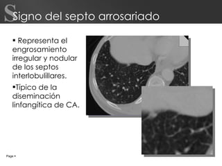 Signo del septo arrosariado Representa el engrosamiento irregular y nodular de los septos interlobulillares. Típico de la diseminación linfangítica de CA. Page     S 