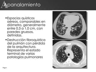 Apanalamiento Espacios quísticos aéreos, comparables en diámetro, generalmente entre 0.3 a 1.0 cm, con paredes gruesas, definidas. Destrucción fibroquística del pulmón con pérdida de la arquitectura. Representa el estado terminal de varias patologías pulmonares Page     A 