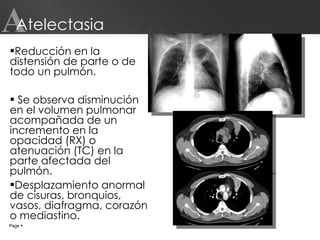 Atelectasia Reducción en la distensión de parte o de todo un pulmón. Se observa disminución en el volumen pulmonar acompañada de un incremento en la opacidad (RX) o atenuación (TC) en la parte afectada del pulmón.  Desplazamiento anormal de cisuras, bronquios, vasos, diafragma, corazón o mediastino. Page     A 
