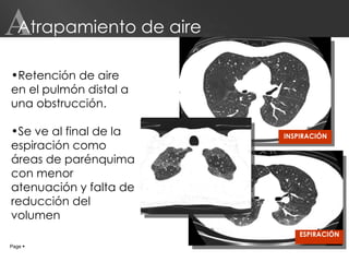 Atrapamiento de aire INSPIRACIÓN Page     A Retención de aire en el pulmón distal a una obstrucción. Se ve al final de la espiración como áreas de parénquima con menor atenuación y falta de reducción del volumen ESPIRACIÓN 