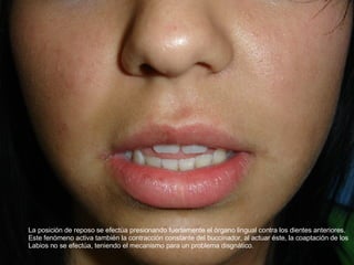 Labio Reposo Glosectomia | PPT