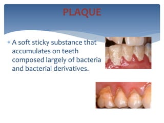  A soft sticky substance that
accumulates on teeth
composed largely of bacteria
and bacterial derivatives.
PLAQUE
 