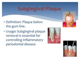  Definition: Plaque below
the gum line.
 Usage: Subgingival plaque
removal is essential for
controlling inflammatory
periodontal disease.
Subgingival Plaque
 