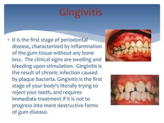  It is the first stage of periodontal
disease, characterized by inflammation
of the gum tissue without any bone
loss. The clinical signs are swelling and
bleeding upon stimulation. Gingivitis is
the result of chronic infection caused
by plaque bacteria. Gingivitis is the first
stage of your body's literally trying to
reject your teeth, and requires
immediate treatment if it is not to
progress into more destructive forms
of gum disease.
Gingivitis
 