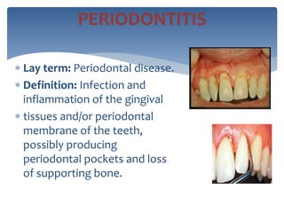  Lay term: Periodontal disease.
 Definition: Infection and
inflammation of the gingival
 tissues and/or periodontal
membrane of the teeth,
possibly producing
periodontal pockets and loss
of supporting bone.
PERIODONTITIS
 