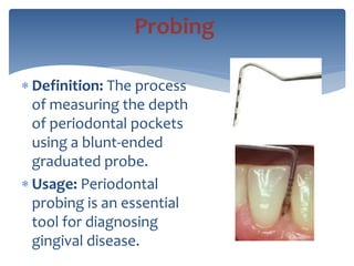 Definition: The process
of measuring the depth
of periodontal pockets
using a blunt-ended
graduated probe.
 Usage: Periodontal
probing is an essential
tool for diagnosing
gingival disease.
Probing
 