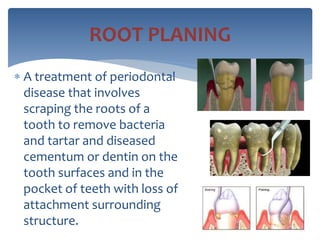  A treatment of periodontal
disease that involves
scraping the roots of a
tooth to remove bacteria
and tartar and diseased
cementum or dentin on the
tooth surfaces and in the
pocket of teeth with loss of
attachment surrounding
structure.
ROOT PLANING
 