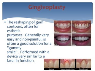  The reshaping of gum
contours, often for
esthetic
purposes. Generally very
easy and non-painful, is
often a good solution for a
"gummy
smile". Performed with a
device very similar to a
laser in function.
Gingivoplasty
 