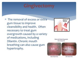  The removal of excess or extra
gum tissue to improve
cleansibility and health. Often
necessary to treat gum
overgrowth caused by a variety
of medications, including
Dilantin. Chronic mouth
breathing can also cause gum
hypertrophy.
Gingivectomy
 
