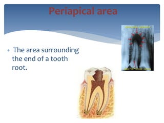  The area surrounding
the end of a tooth
root.
Periapical area
 