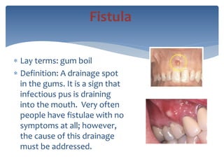  Lay terms: gum boil
 Definition: A drainage spot
in the gums. It is a sign that
infectious pus is draining
into the mouth. Very often
people have fistulae with no
symptoms at all; however,
the cause of this drainage
must be addressed.
Fistula
 