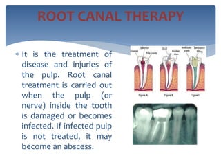  It is the treatment of
disease and injuries of
the pulp. Root canal
treatment is carried out
when the pulp (or
nerve) inside the tooth
is damaged or becomes
infected. If infected pulp
is not treated, it may
become an abscess.
ROOT CANAL THERAPY
 
