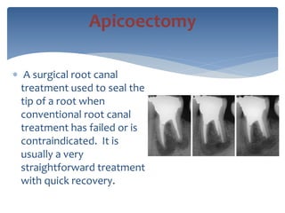  A surgical root canal
treatment used to seal the
tip of a root when
conventional root canal
treatment has failed or is
contraindicated. It is
usually a very
straightforward treatment
with quick recovery.
Apicoectomy
 