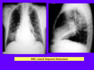 Glossary of thoracic imaging terms part 1 | PDF