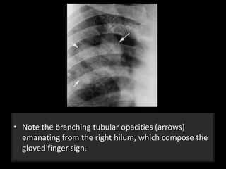 Button Sign Navicular Gloved finger sign and cervicothoracic sign | PPTX