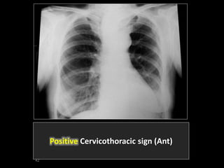 Stuart Sign Cervical Gloved finger sign and cervicothoracic sign | PPTX