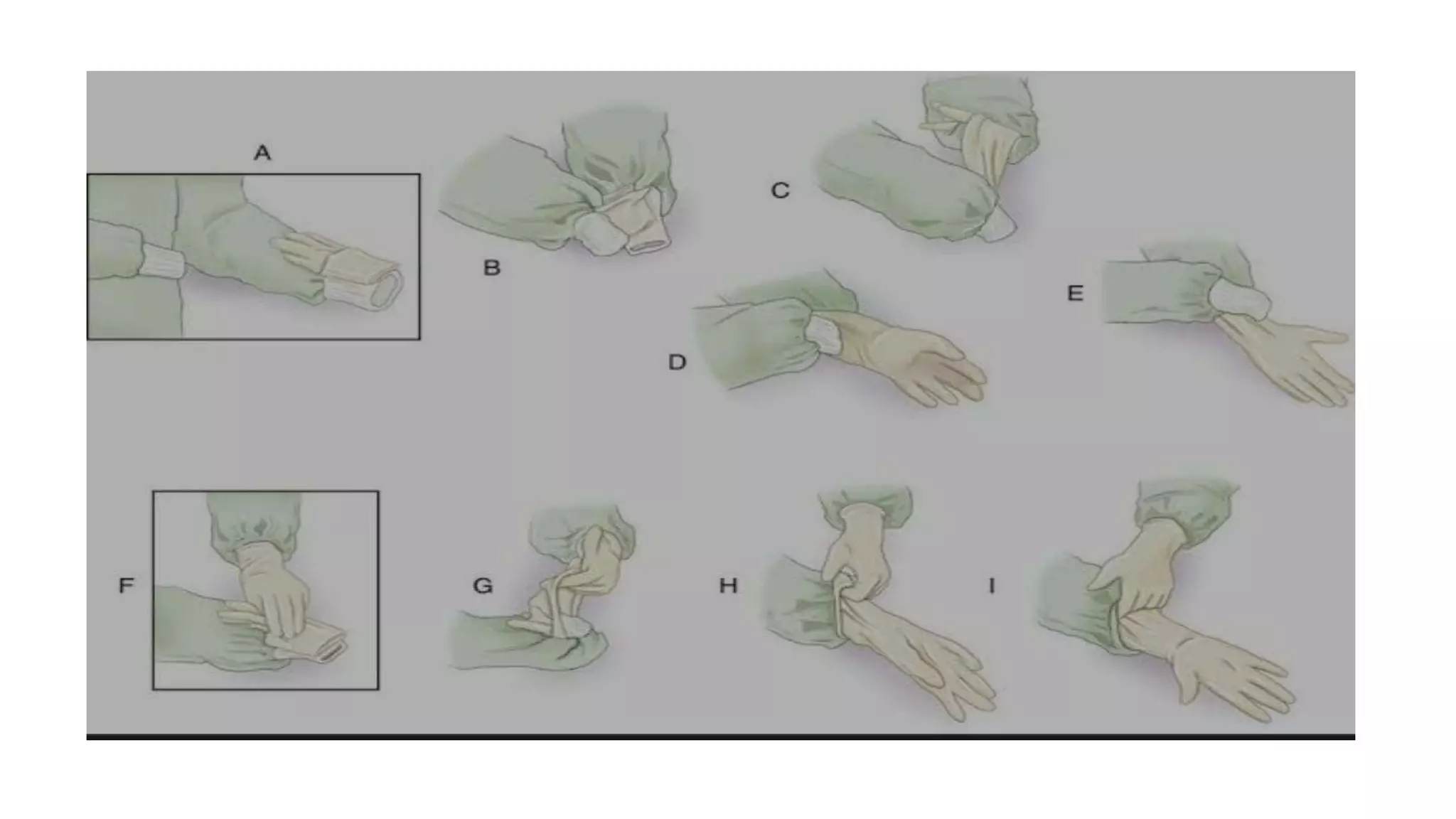 gloving-degloving-pptx