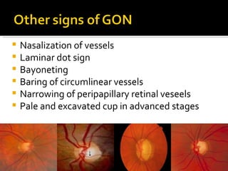 Gluacoma clinical evaluation | PPT