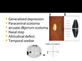Gluacoma clinical evaluation | PPT