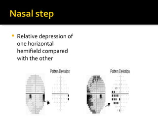 Gluacoma clinical evaluation | PPT