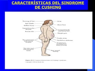 CARACTERÍSTICAS DEL SINDROME DE CUSHING 