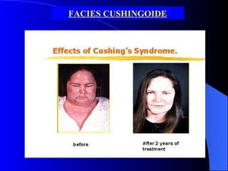 FACIES CUSHINGOIDE 