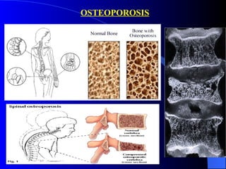 OSTEOPOROSIS 