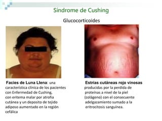 Síndrome de Cushing
                                     Glucocorticoides




Facies de Luna Llena: una                      Estrías cutáneas rojo vinosas
característica clínica de los pacientes       producidas por la perdida de
con Enfermedad de Cushing,                    proteínas a nivel de la piel
con eritema malar por atrofia                 (colágeno) con el consecuente
cutánea y un deposito de tejido               adelgazamiento sumado a la
adiposo aumentado en la región                 eritrocitosis sanguínea.
cefálica
 
