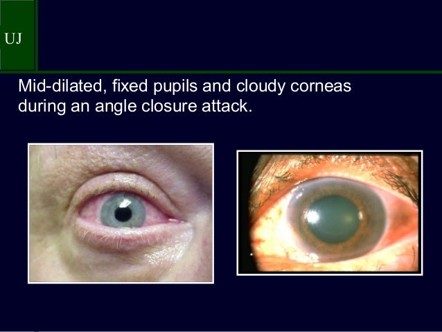 Dilated Eyes Panic Attack