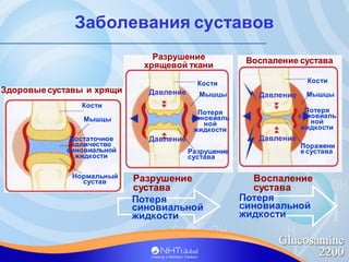 Заболевания суставов
Разрушение
сустава
Потеря
синовиальной
жидкости
Разрушение
хрящевой ткани
Давление
Давление
Кости
Мыш...