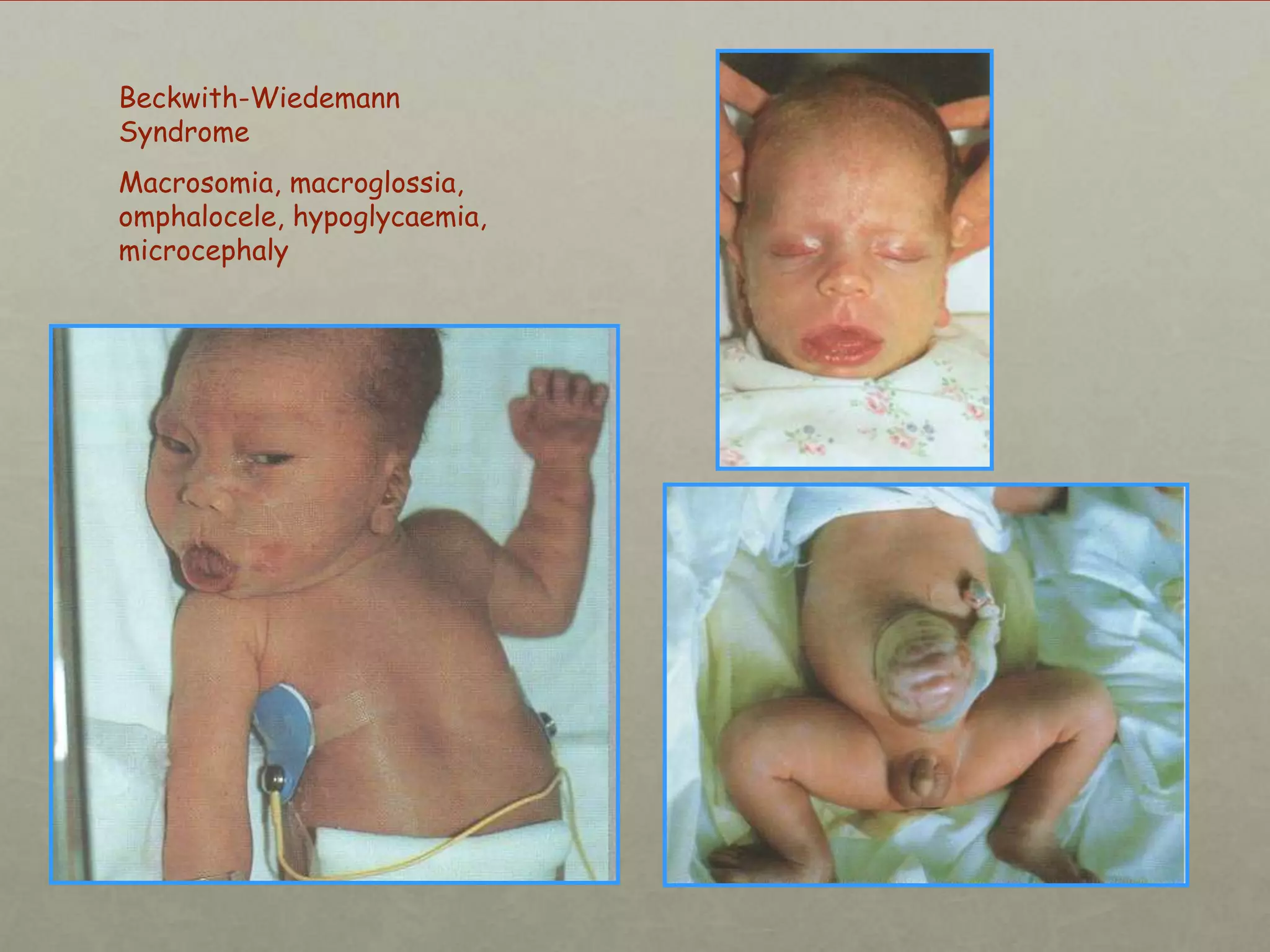Beckwith-Wiedemann
Syndrome
Macrosomia, macroglossia,
omphalocele, hypoglycaemia,
microcephaly

 