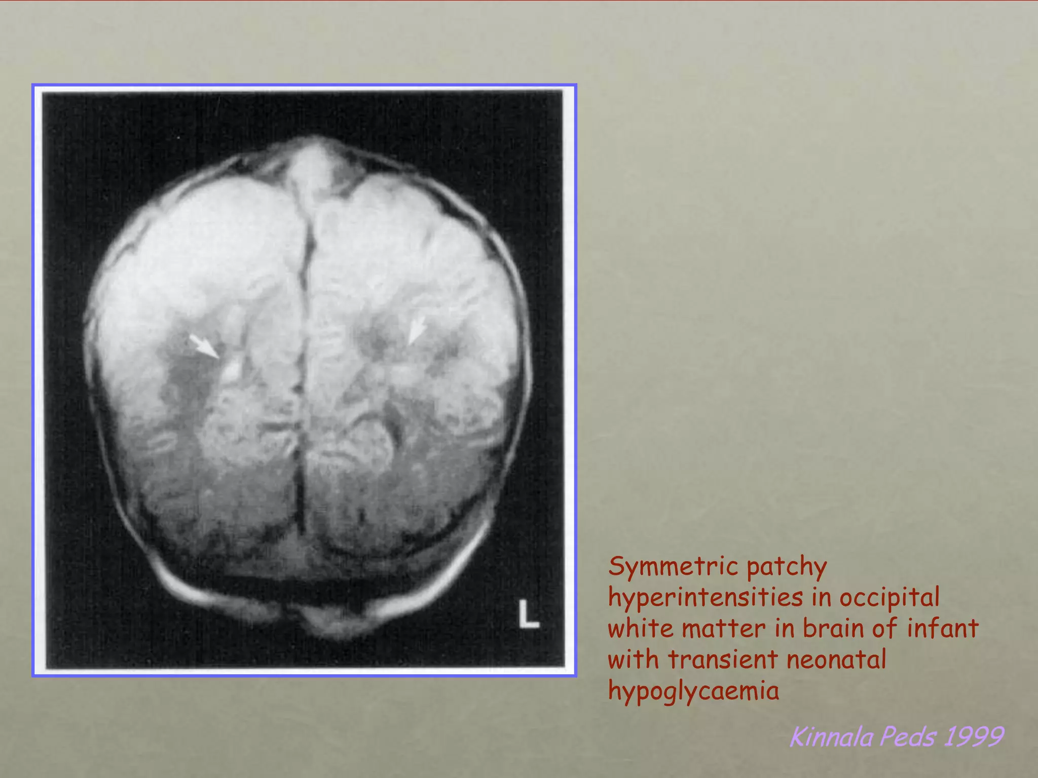 Symmetric patchy
hyperintensities in occipital
white matter in brain of infant
with transient neonatal
hypoglycaemia

Kinnala Peds 1999

 