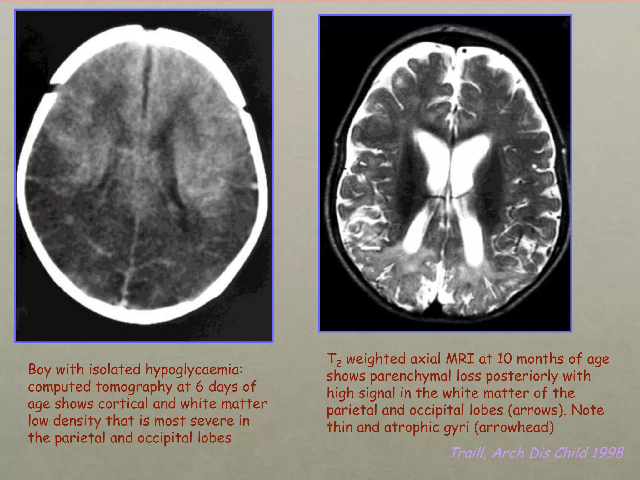 Boy with isolated hypoglycaemia:
computed tomography at 6 days of
age shows cortical and white matter
low density that is most severe in
the parietal and occipital lobes

T2 weighted axial MRI at 10 months of age
shows parenchymal loss posteriorly with
high signal in the white matter of the
parietal and occipital lobes (arrows). Note
thin and atrophic gyri (arrowhead)

Traill, Arch Dis Child 1998

 