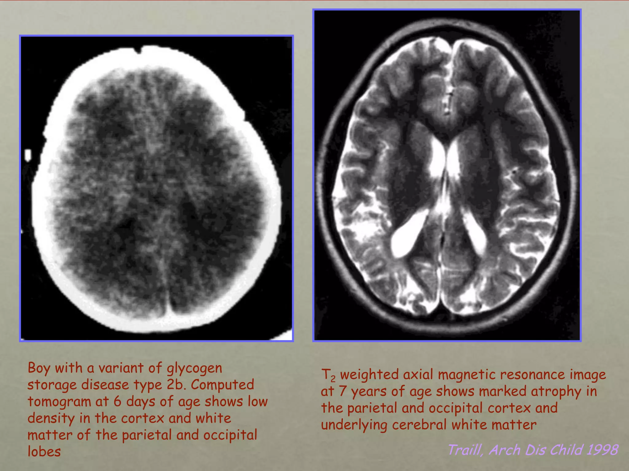 Boy with a variant of glycogen
storage disease type 2b. Computed
tomogram at 6 days of age shows low
density in the cortex and white
matter of the parietal and occipital
lobes

T2 weighted axial magnetic resonance image
at 7 years of age shows marked atrophy in
the parietal and occipital cortex and
underlying cerebral white matter

Traill, Arch Dis Child 1998

 