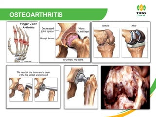 OSTEOARTHRITIS
 