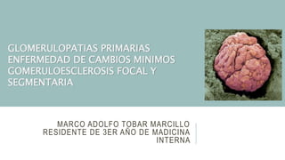 MARCO ADOLFO TOBAR MARCILLO
RESIDENTE DE 3ER AÑO DE MADICINA
INTERNA
GLOMERULOPATIAS PRIMARIAS
ENFERMEDAD DE CAMBIOS MINIMOS
GOMERULOESCLEROSIS FOCAL Y
SEGMENTARIA
 