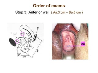Order of exams Step 3: Anterior wall   ( Aa:3 cm – Ba:6 cm ) 