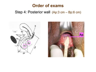 Order of exams Step 4: Posterior wall   (Ap:3 cm – Bp:6 cm) 