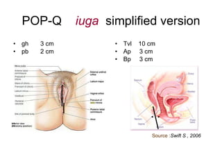 POP-Q  iuga   simplified version gh  3 cm pb  2 cm Tvl  10 cm Ap  3 cm Bp  3 cm Source : Swift S , 2006 