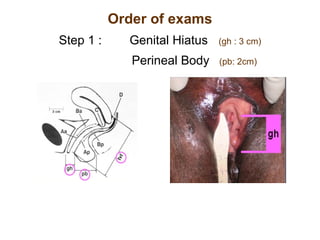 Order of exams Step 1 :  Genital Hiatus   (gh : 3 cm)   Perineal Body   (pb: 2cm) 