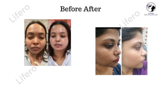 Before After
Lifero
Lifero
Lifero
 