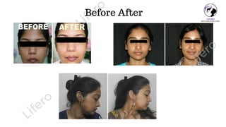 Lifero
Lifero
Lifero
Before After
 