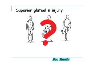 Superior gluteal n injury
 