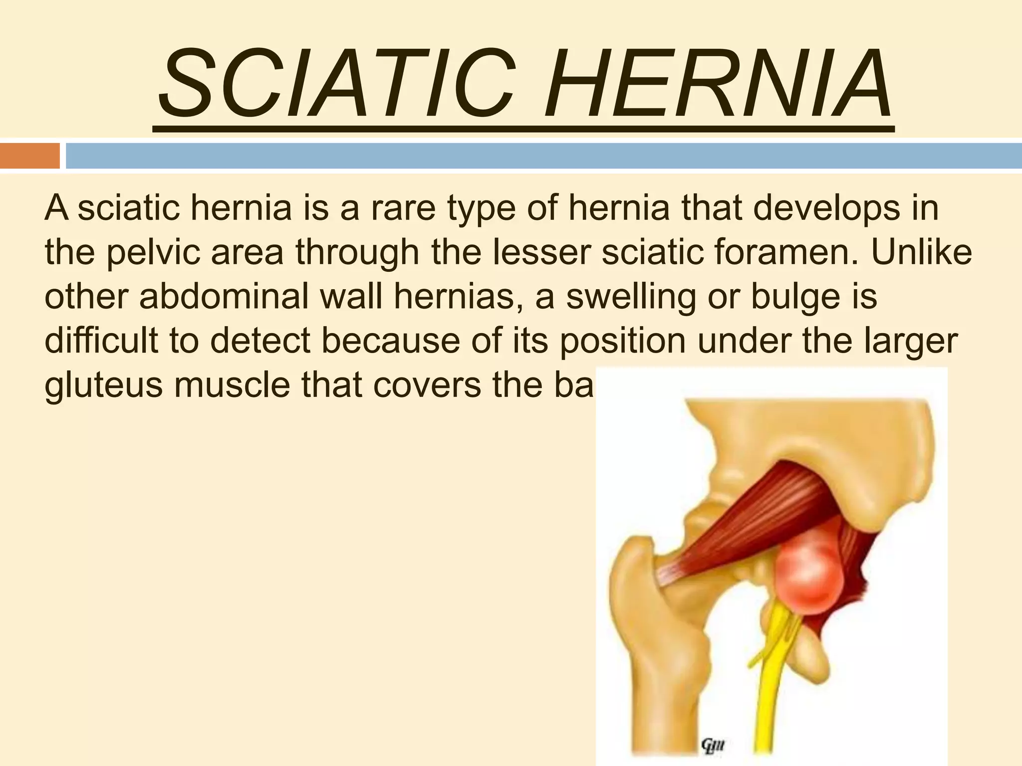 SCIATIC HERNIA
A sciatic hernia is a rare type of hernia that develops in
the pelvic area through the lesser sciatic foramen. Unlike
other abdominal wall hernias, a swelling or bulge is
difficult to detect because of its position under the larger
gluteus muscle that covers the back of the pelvis.
 