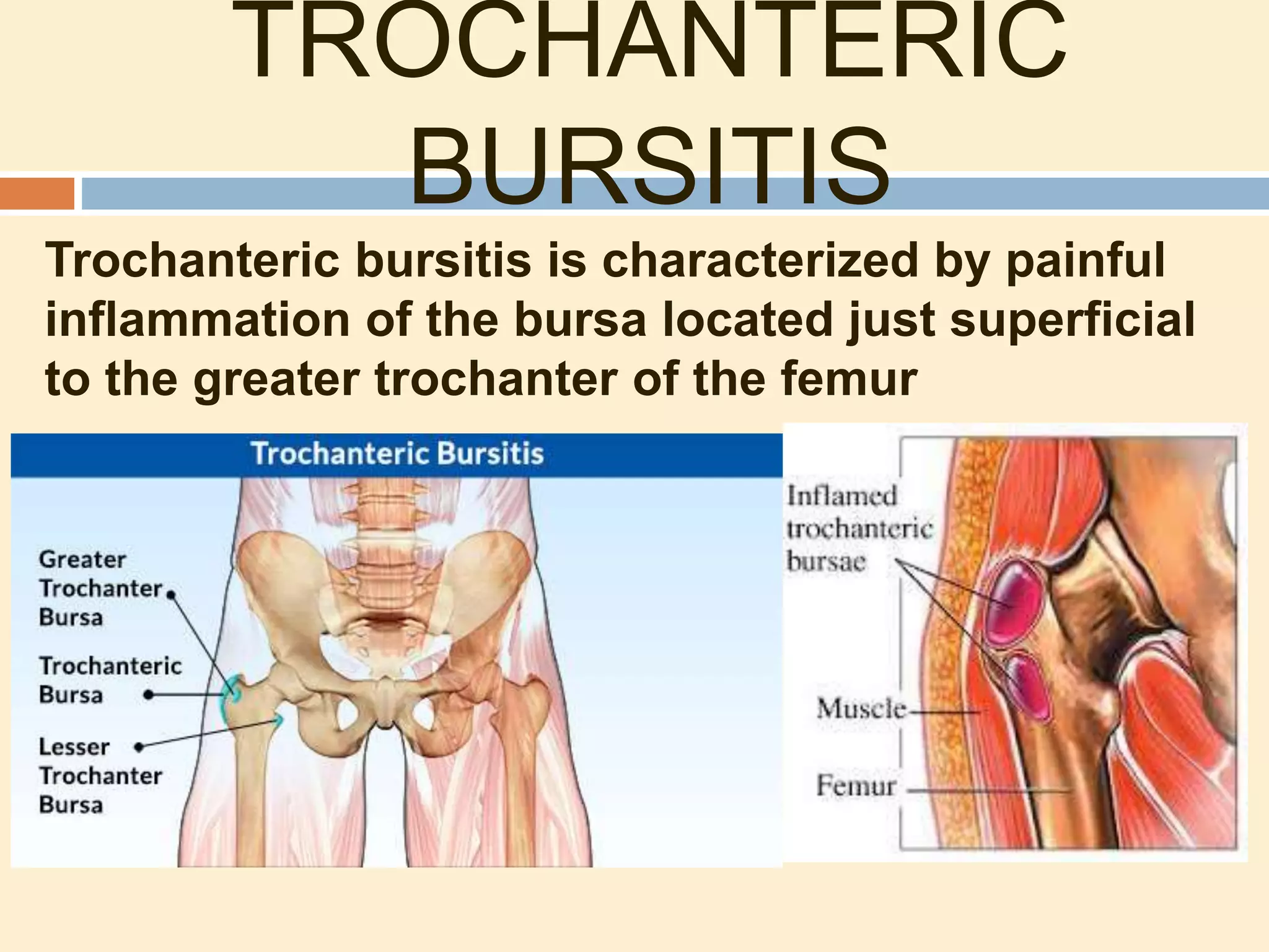 TROCHANTERIC
BURSITIS
Trochanteric bursitis is characterized by painful
inflammation of the bursa located just superficial
to the greater trochanter of the femur
 
